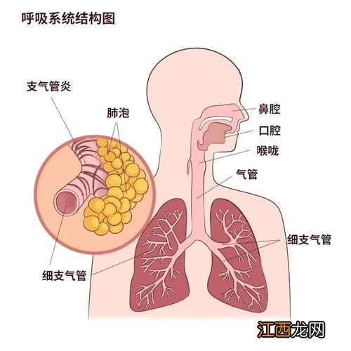 气管炎咳嗽吃什么药最有效 支气管炎吃什么能好