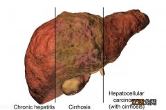 肝硬化不能吃的食物有哪些 肝硬化不可以吃什么蔬菜