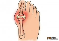 脚痛风不能吃什么东西 脚通风吃什么好的快