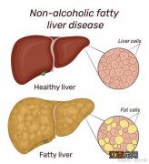 肝病不能吃什么东西 肝病不适合吃的食物有哪些