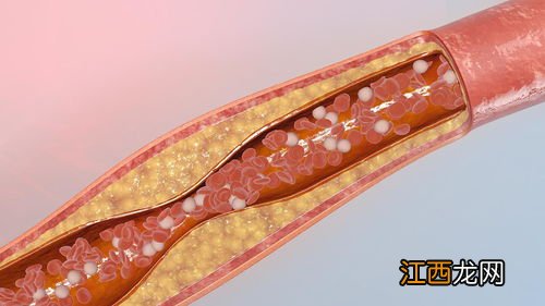 预防血管硬化的食物 吃什么食物可以预防动脉硬化