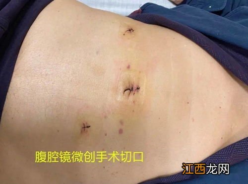 阑尾炎手术后吃什么好 阑尾炎病人可以吃什么