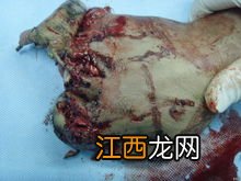 阑尾炎手术后吃什么好 阑尾炎病人可以吃什么