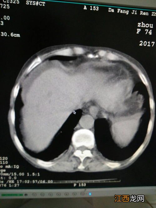 肝硬化腹水可以吃什么食物 肝硬化腹水可以吃什么食物