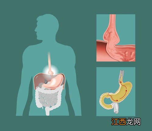 急性胆囊炎吃什么好 急性胆囊炎能吃什么食物好