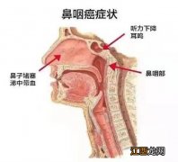 鼻咽癌可以吃鱼吗 鼻咽癌能吃什么食物好