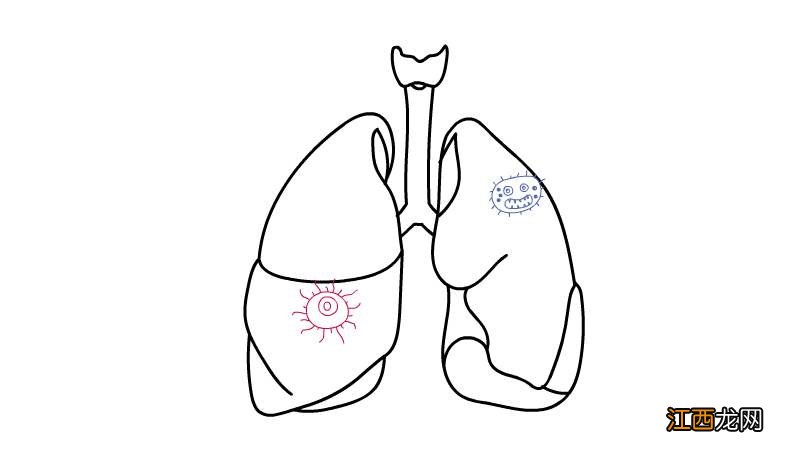 肺炎简笔画 肺炎简笔画步骤