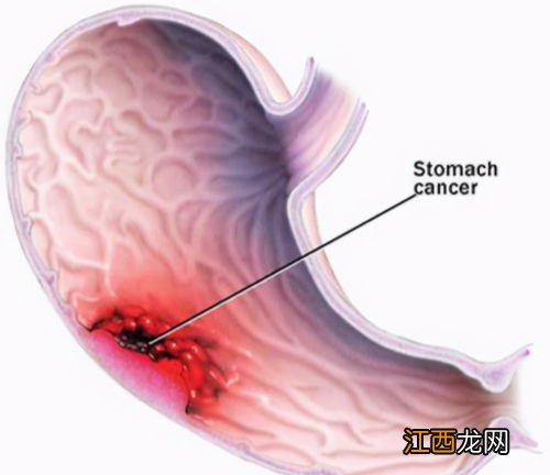 慢性糜烂性胃炎吃什么肉好 慢性糜烂性胃炎吃什么肉好