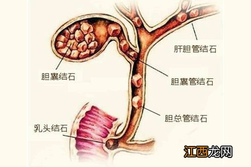 胆结石患者如何饮食 胆结石能吃什么食物