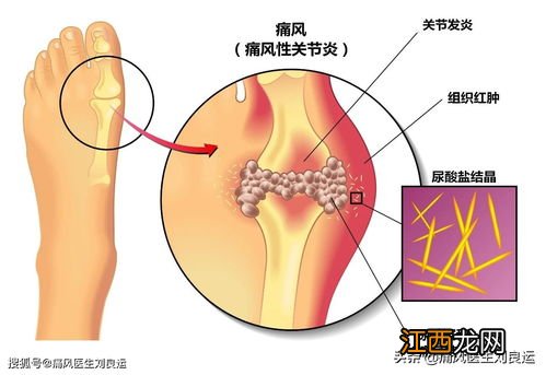 吃什么能缓解痛风 疼风吃什么药效果好