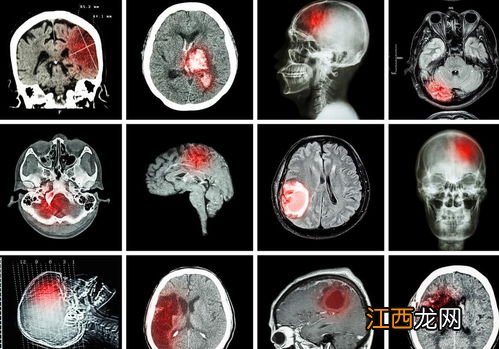 脑梗塞不能吃哪些东西 没有三高为啥得脑梗应该吃什么药
