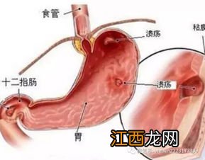 胃溃疡怎么食疗调理 胃溃疡怎么饮食