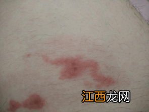 湿疹病人吃什么食物好 湿疹患者可以吃什么