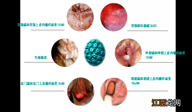 四价疫苗三针一共多少钱 四价疫苗三针间隔时间多久