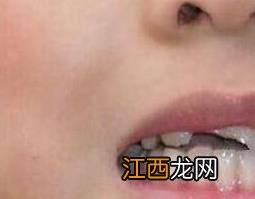 嘴上上火起泡怎么办 嘴上上火起泡怎么办好得快 知乎