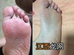 ?如何治脚气