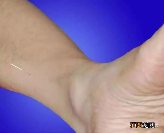 扎针灸图片高清图片 扎针灸图片