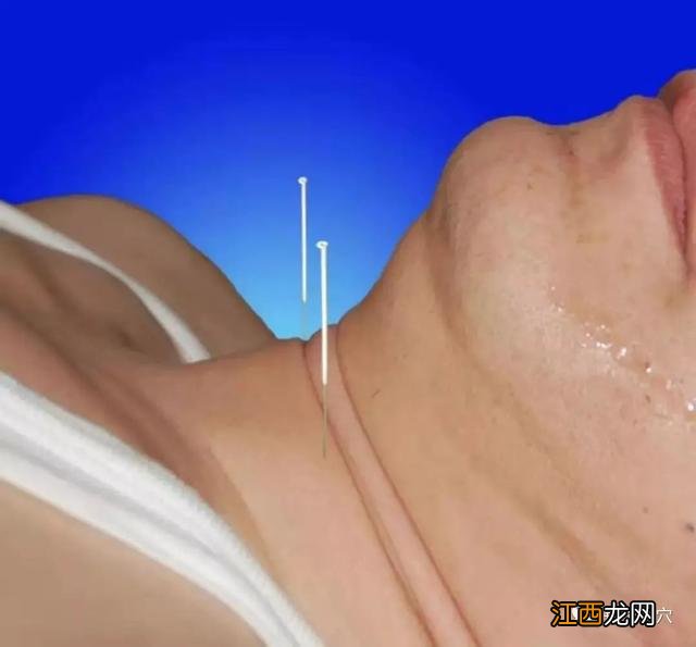扎针灸图片高清图片 扎针灸图片