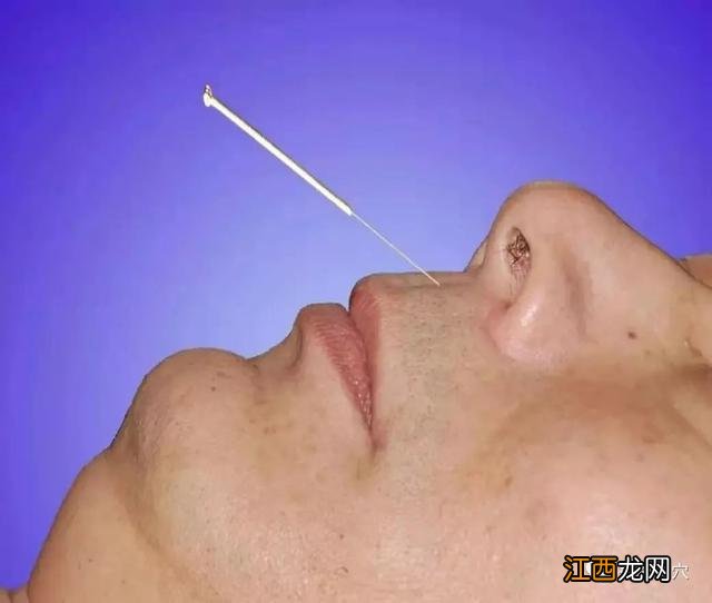 扎针灸图片高清图片 扎针灸图片