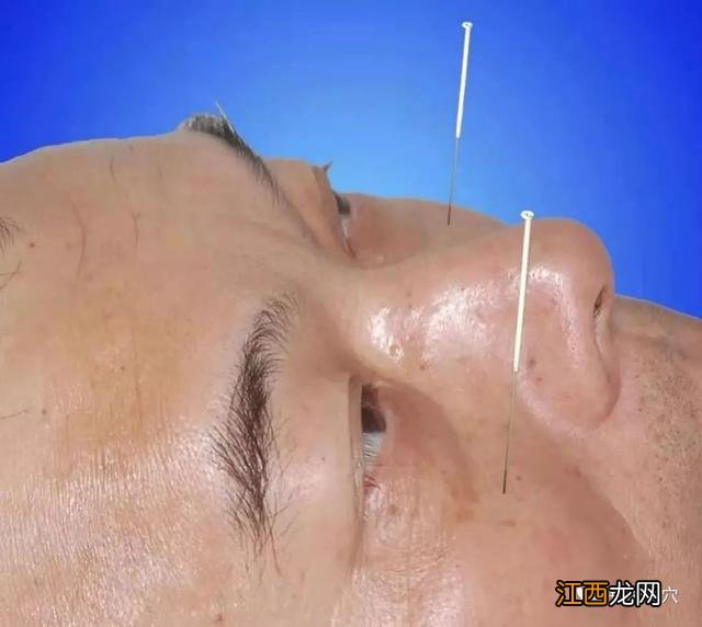 扎针灸图片高清图片 扎针灸图片