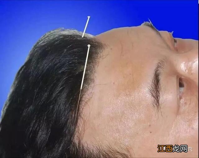 扎针灸图片高清图片 扎针灸图片