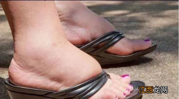 脚上各种皮肤病对照图 脚底发红好像充血一样