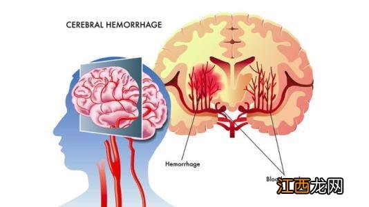 脑缺血症状有哪些症状 脑淤血的前兆什么症状