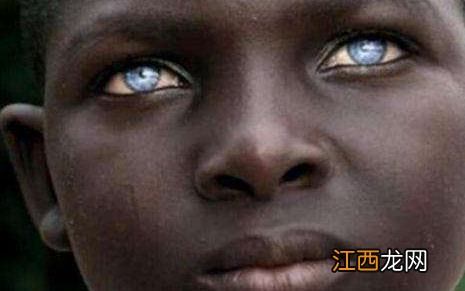 宝宝白眼珠发蓝图片 宝宝眼白发蓝图片