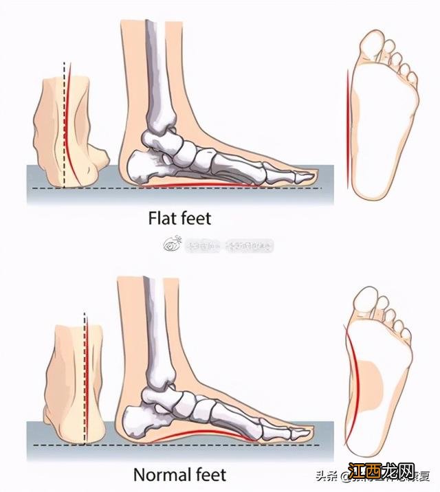 儿童扁平足怎么矫正 扁平足如何治疗