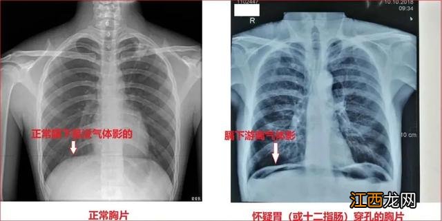 急性肠胃炎会不会死 急性肠胃炎会死人吗