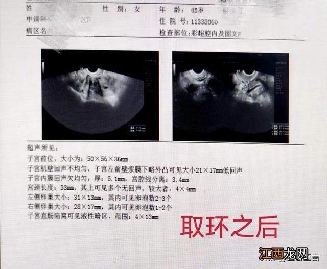 爱母环多少钱一个月 爱母环多少钱一个