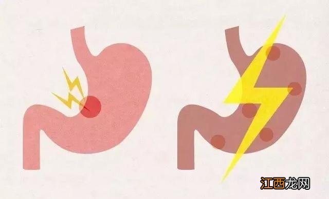 胃溃疡表现有哪些症状 胃溃疡表现