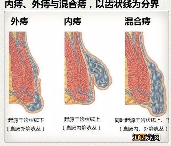 女生长痔疮怎么自愈 痔疮怎么自愈