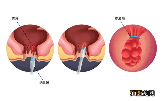 男生用卫生巾