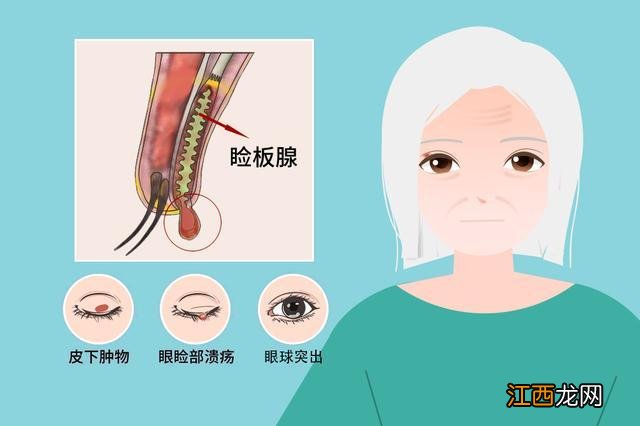 上眼皮上长了个疙瘩图片 上眼皮里面长了个疙瘩图片