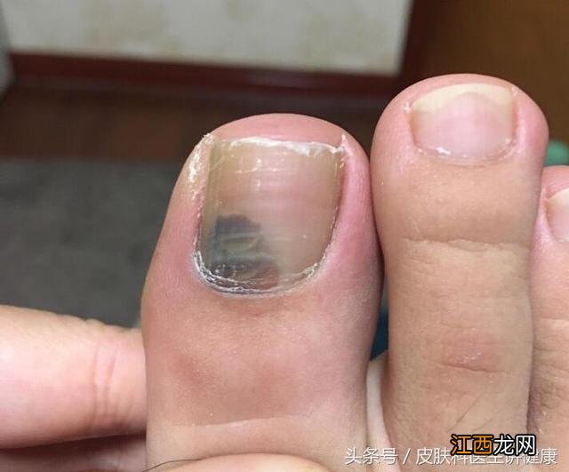 脚趾甲里面有黑块瘀血 脚趾甲里面有黑块
