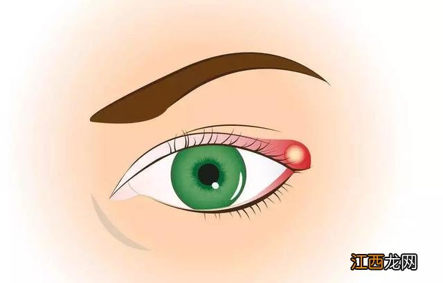 眼角长麦粒肿 麦粒肿图片下眼皮