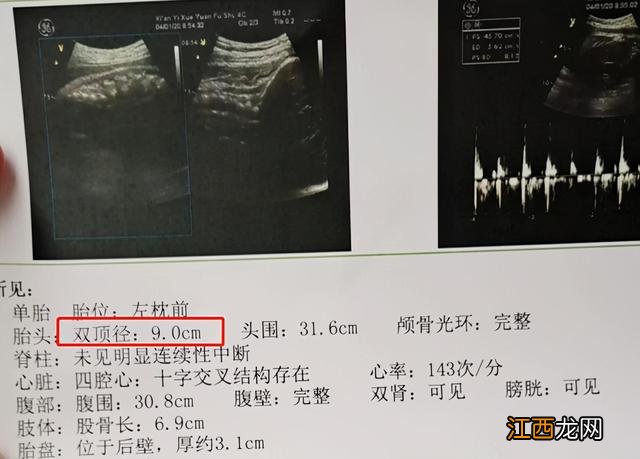 双顶径跟头围有什么关系 头围和双顶径的关系