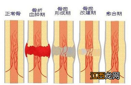 骨痂形成是骨折好了吗 骨痂形成什么意思