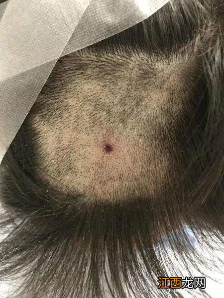 蜱虫咬人后的伤口图片大全 蜱虫咬人后的伤口图