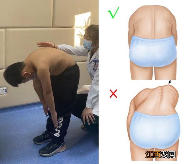 儿童脊柱侧弯的危害和症状 儿童脊柱侧弯