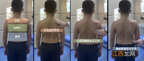 儿童脊柱侧弯的危害和症状 儿童脊柱侧弯