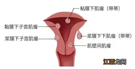 宫瘤消胶囊的功效和作用 宫瘤消胶囊的功效