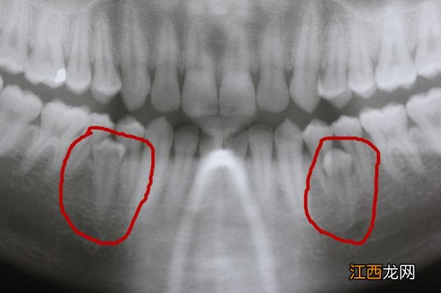 门牙中间多生牙矫正图 上门牙多生牙图片