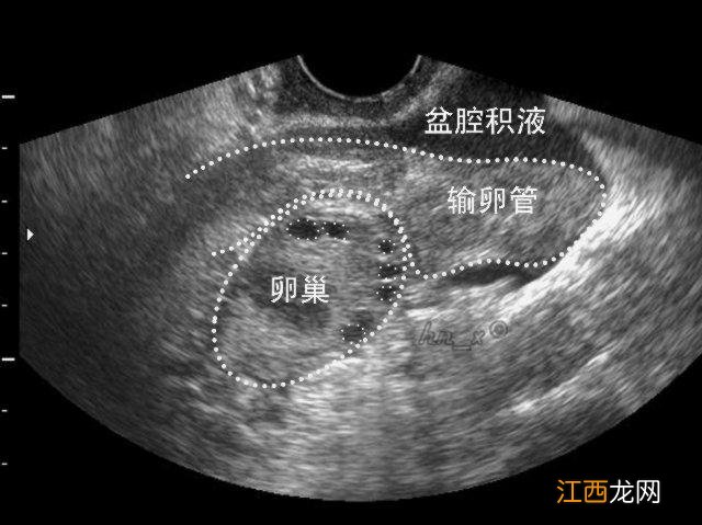 盆腔有少量积液怎么治疗 盆腔积液怎么排出