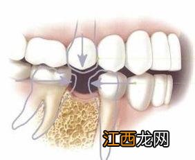 磨牙齿怎么治疗最有效 磨牙齿怎么治疗