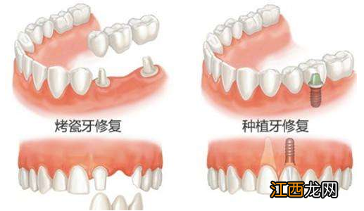 磨牙齿怎么治疗最有效 磨牙齿怎么治疗