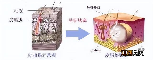 阴囊上的毛囊炎图片 阴囊毛囊炎的症状和图片