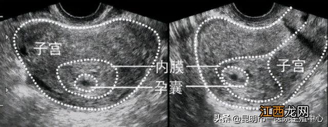 怀孕空囊还可以补救吗 空囊最明显的症状