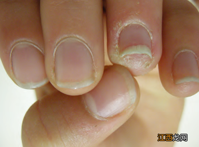 额头长疣图片大全 疣图片大全